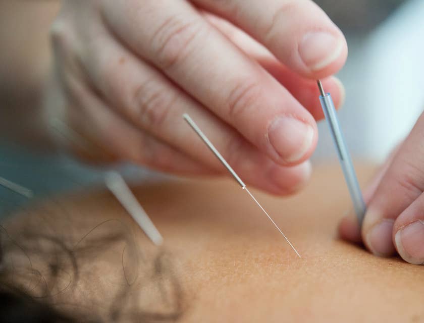 Close-up of someone inserting acupuncture needles into a person's skin.