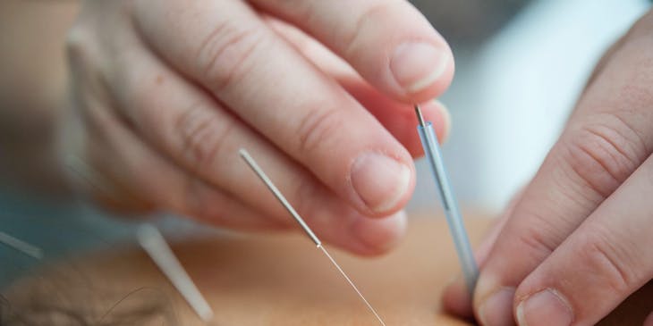 Dry needles being inserted into a patient's back.