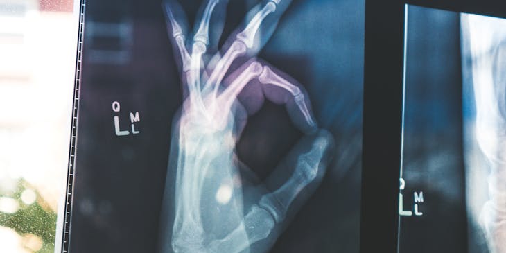 X-ray of hand giving the O.K. sign at a rehabilitation center.