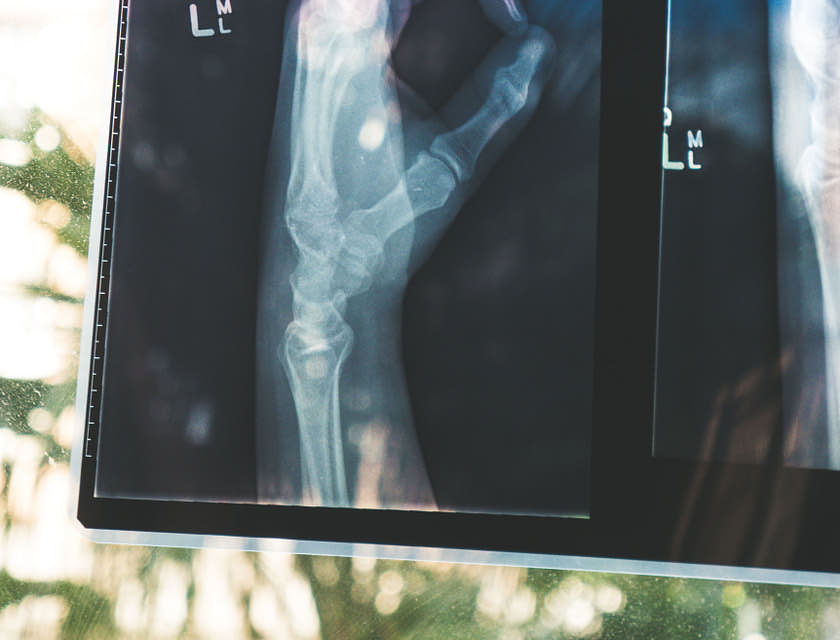 Radiographie d'une main faisant le signe O.K. dans un centre de convalescence