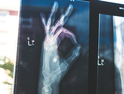 Radiografia di una mano che dà un segno di ok in un centro di recupero.
