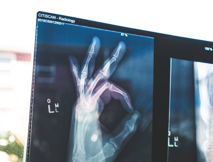Radiografia di una mano che dà un segno di ok in un centro di recupero.