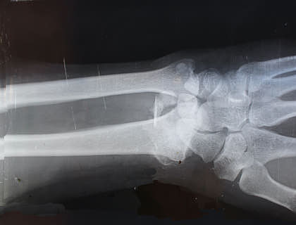 Rayos x de una muñeca en un consultorio de un reumatólogo.